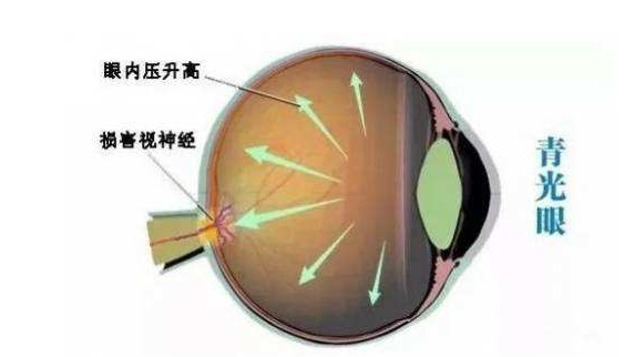 视力矫正,视力加盟,青光眼
