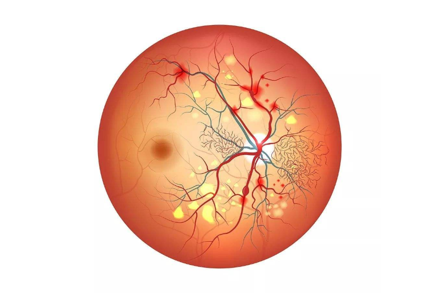 视力矫正,视力加盟,视网膜